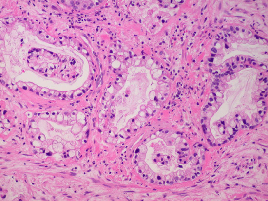 Clear cell carcinoma of Endometrium (1)