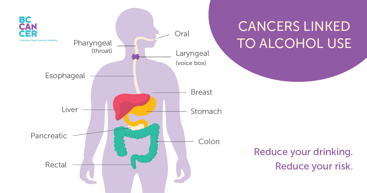 Cancers linked to alcohol