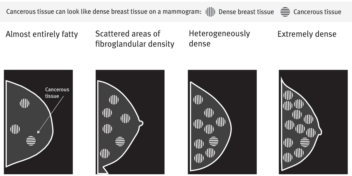 Breast Density